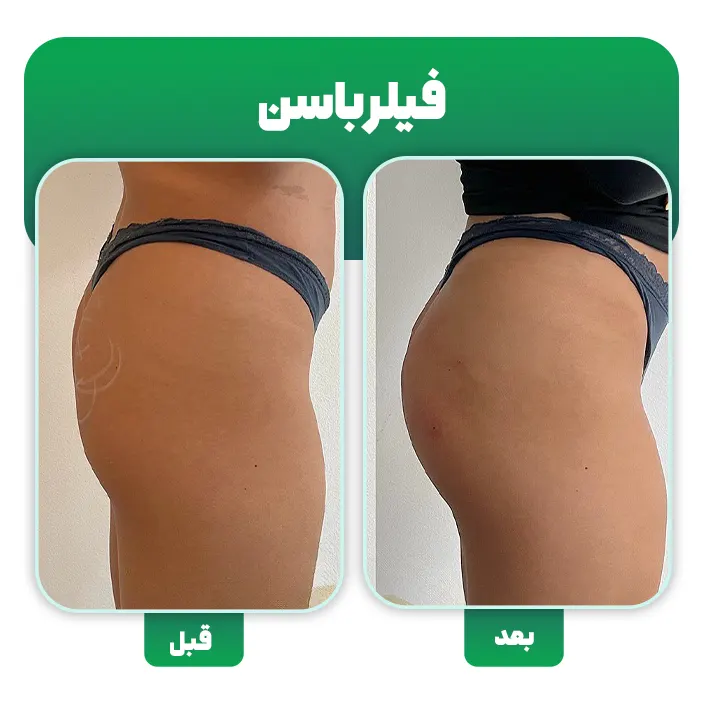 فیلر باسن