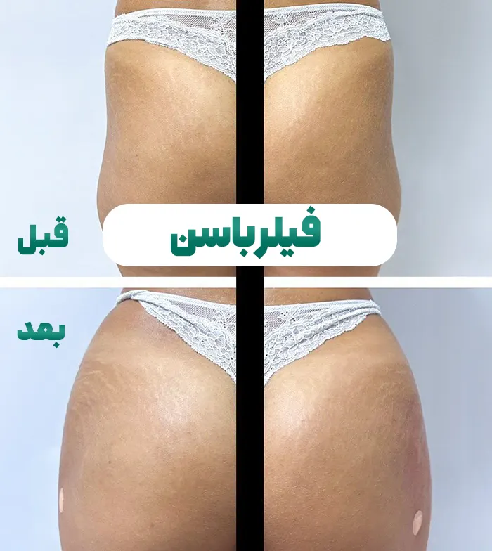 فیلر باسن