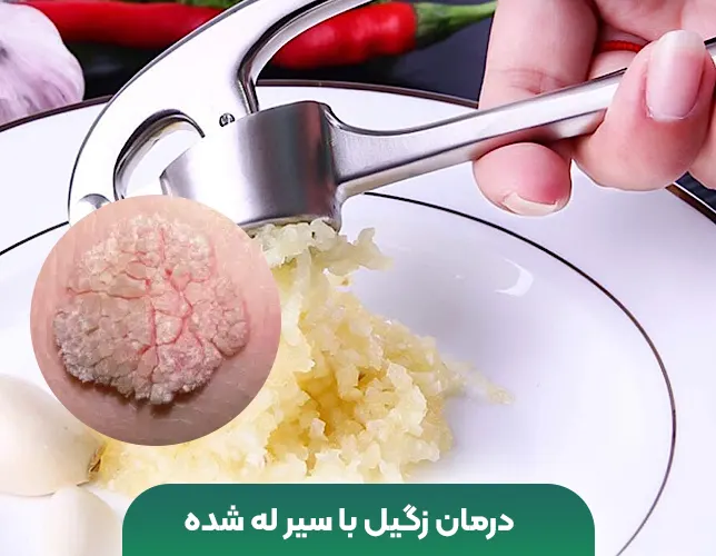 درمان زگیل سیر له شده