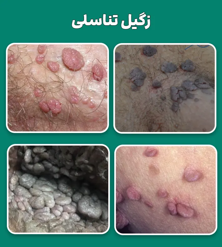 زگیل تناسلی