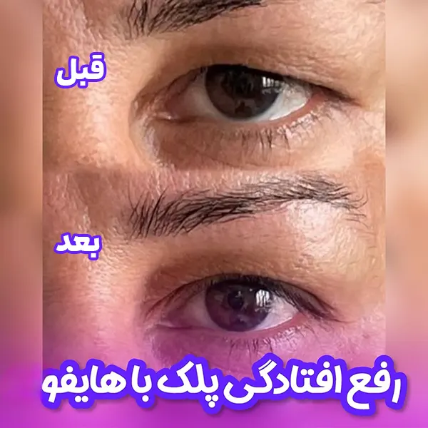 درمان افتادگی پلک با هایفو
