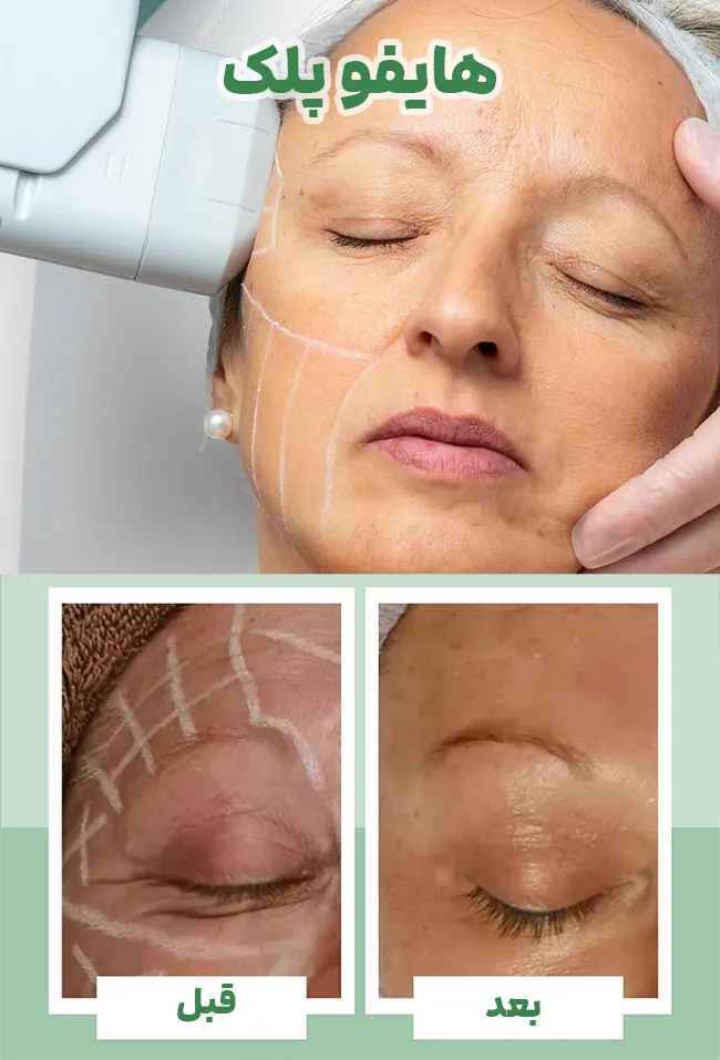 درمان افتادگی پلک با هایفو