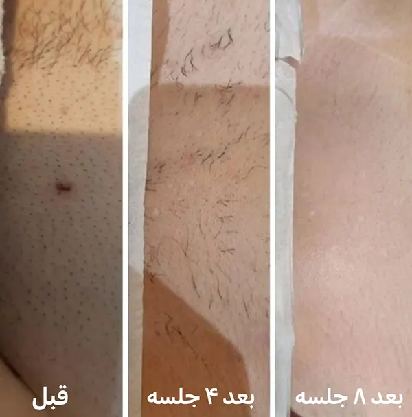 قبل و بعد لیزر بیکینی