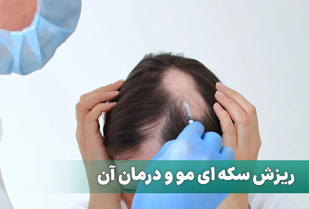 ریزش سکه ای مو و درمان آن