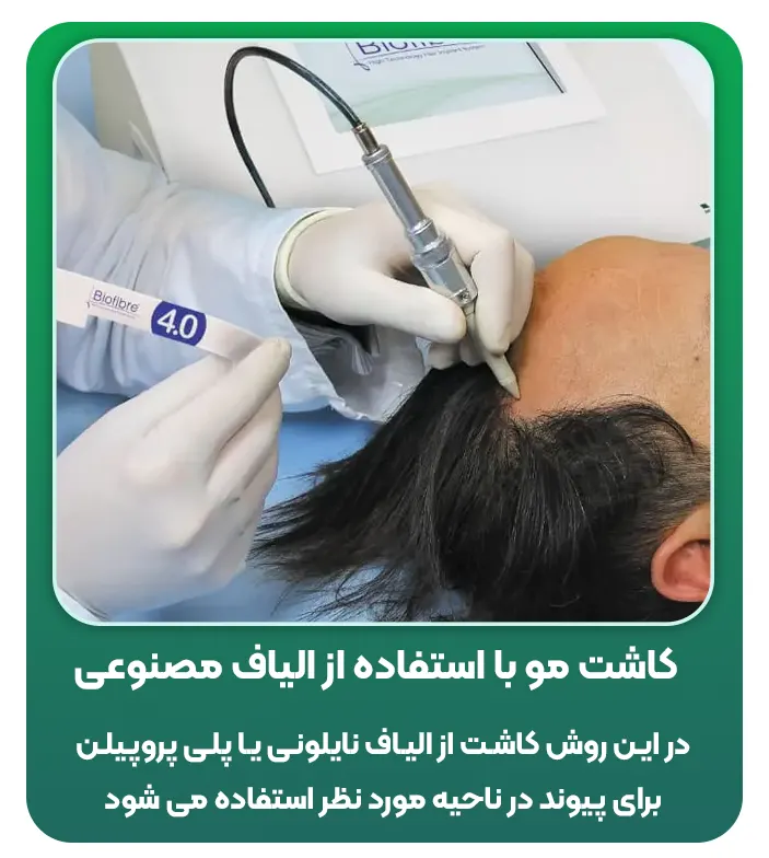 کاشت مو با استفاده از الیاف مصنوعی