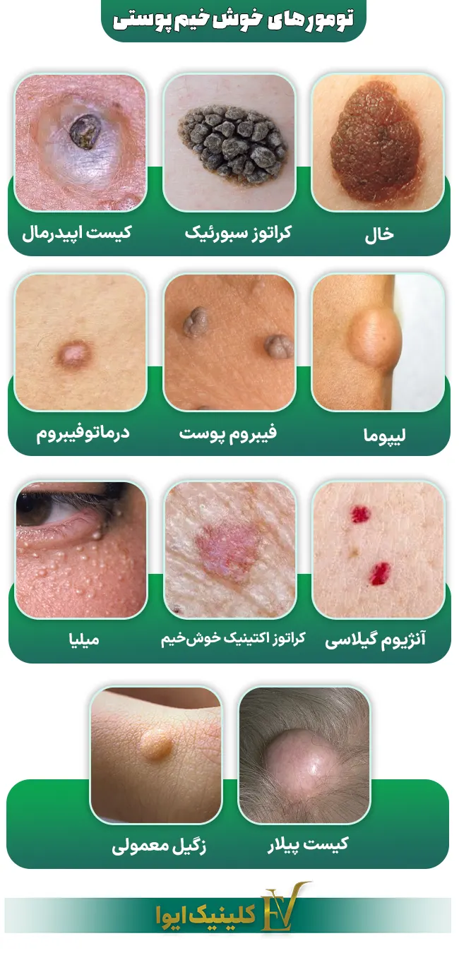 از کجا بفهمیم خال سرطانی است؟