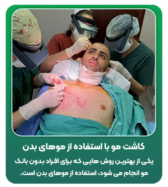 کاشت مو با استفاده از موهای بدن