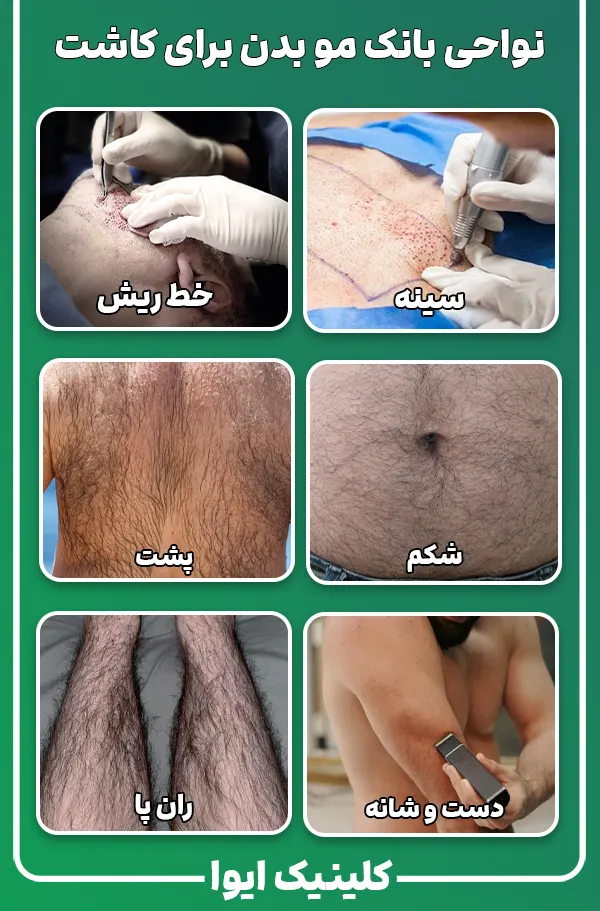انواع بانک مو برای کاشت