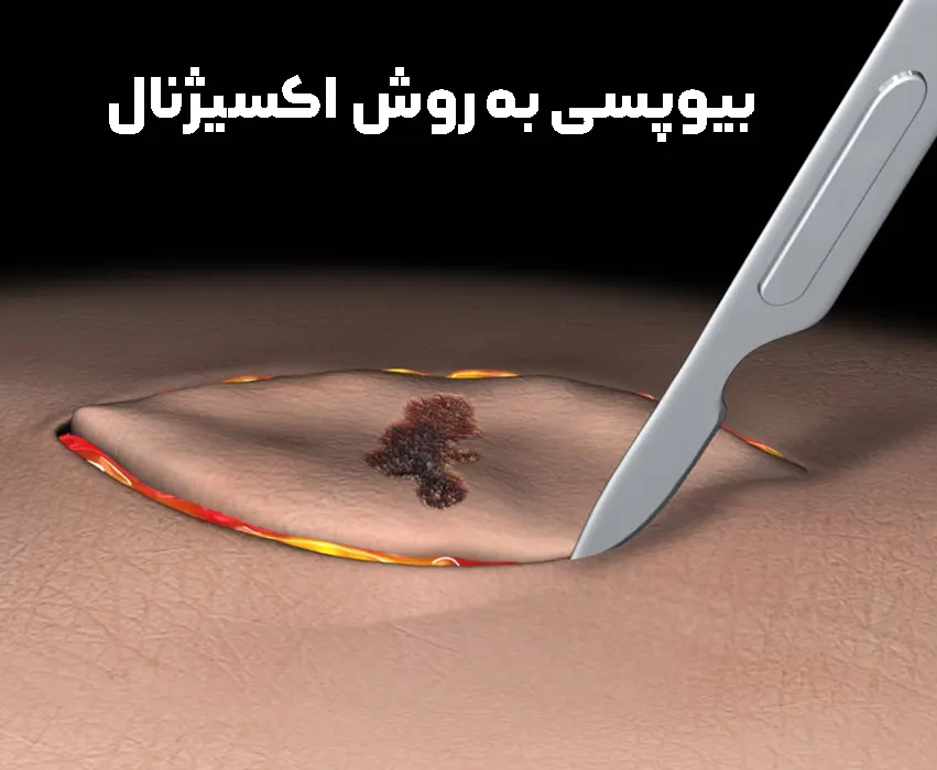 بیوپسی اکسیژنال