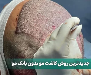 جدیدترین روش کاشت مو بدون بانک مو