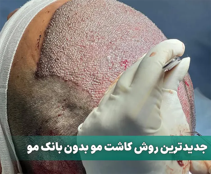 جدیدترین روش کاشت مو بدون بانک مو