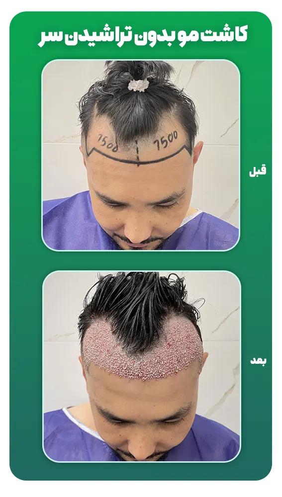 کاشت مو بدون تراشیدن سر
