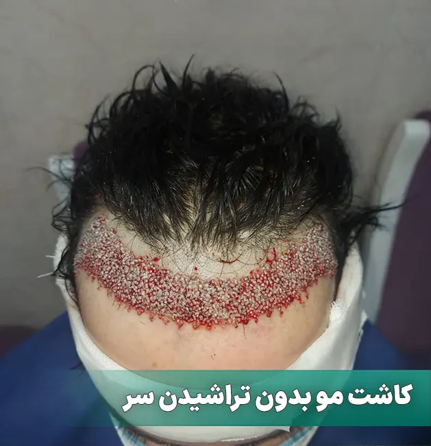 کاشت مو بدون تراشیدن سر
