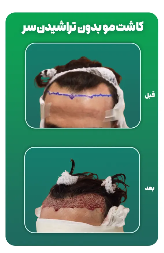 کاشت مو بدون تراشیدن سر