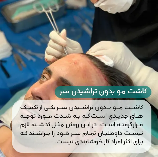 کاشت مو بدون تراشیدن سر