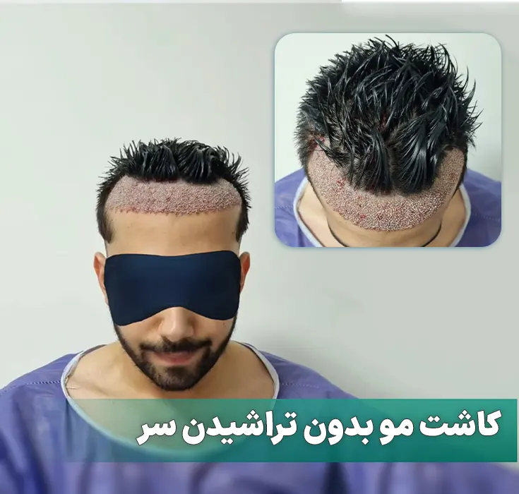 کاشت مو بدون تراشیدن سر