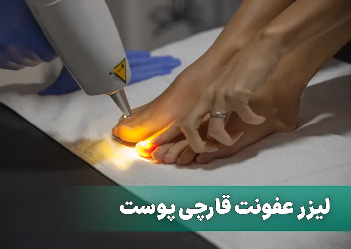 لیزر عفونت قارچی پوست