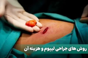 جراحی لیپوم