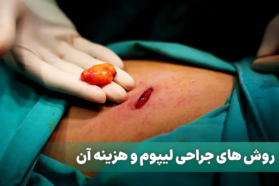 جراحی لیپوم