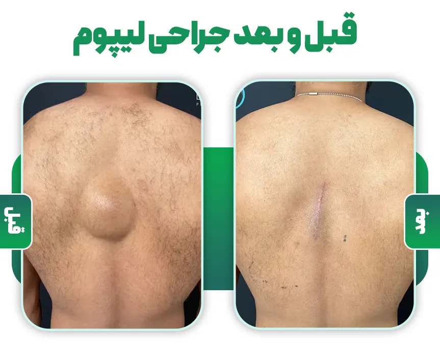 قبل و بعد جراحی لیپوم