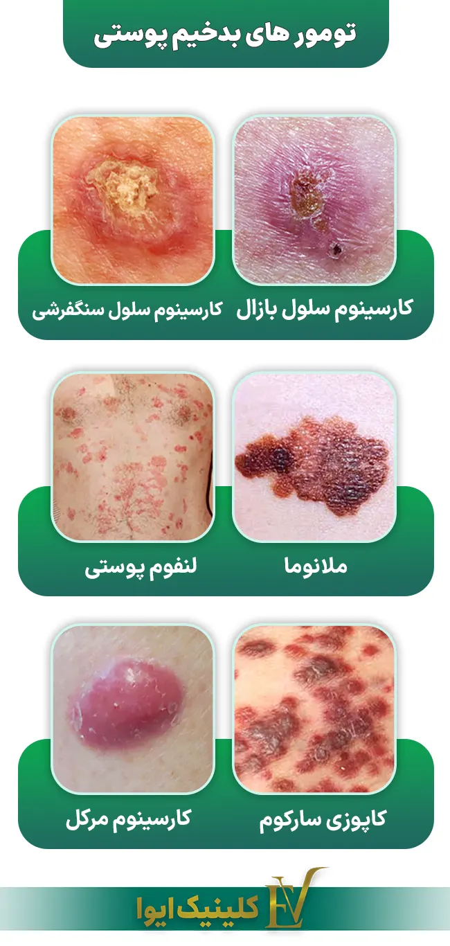 تومور های بدخیم پوستی