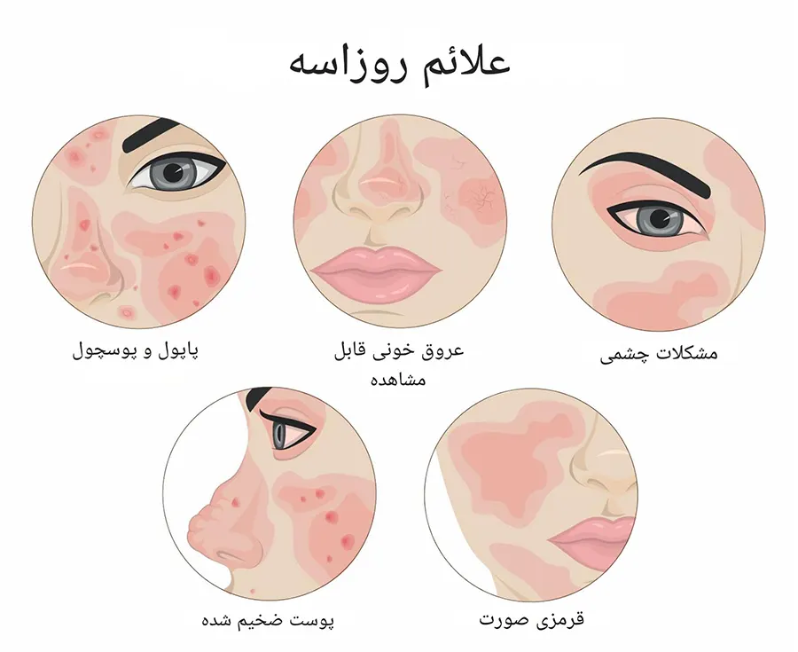 علائم روزاسه