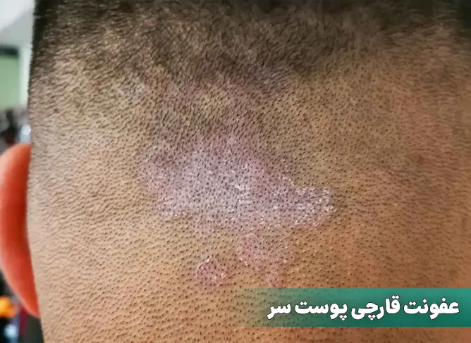 قارچ پوست سر