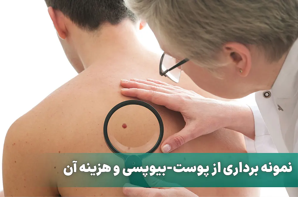 نمونه برداری از پوست-بیوپسی