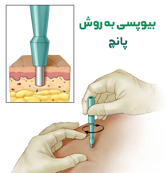 بیوپسی پانچ