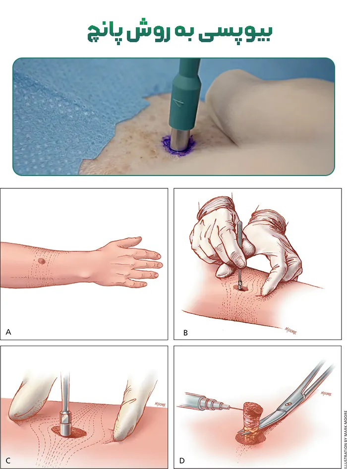 بیوپسی پانچ