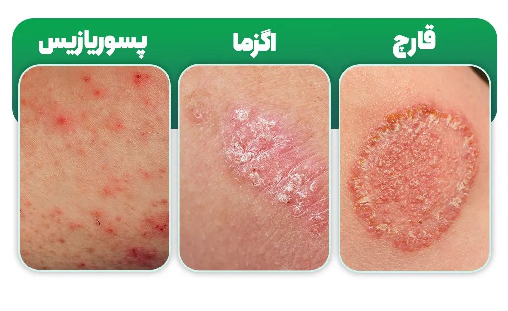 تفاوت عفونت قارچی و اگزما و پسوریازیس