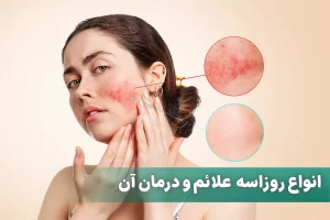 بیماری پوستی روزاسه