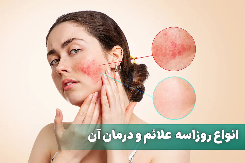 بیماری پوستی روزاسه