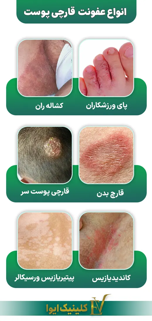 انواع عفونت‌های قارچی پوست