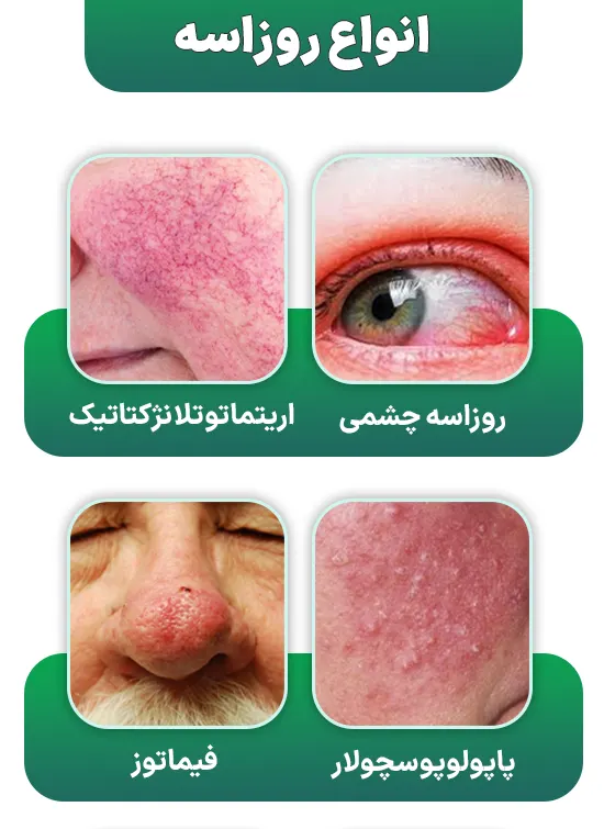 انواع روزاسه