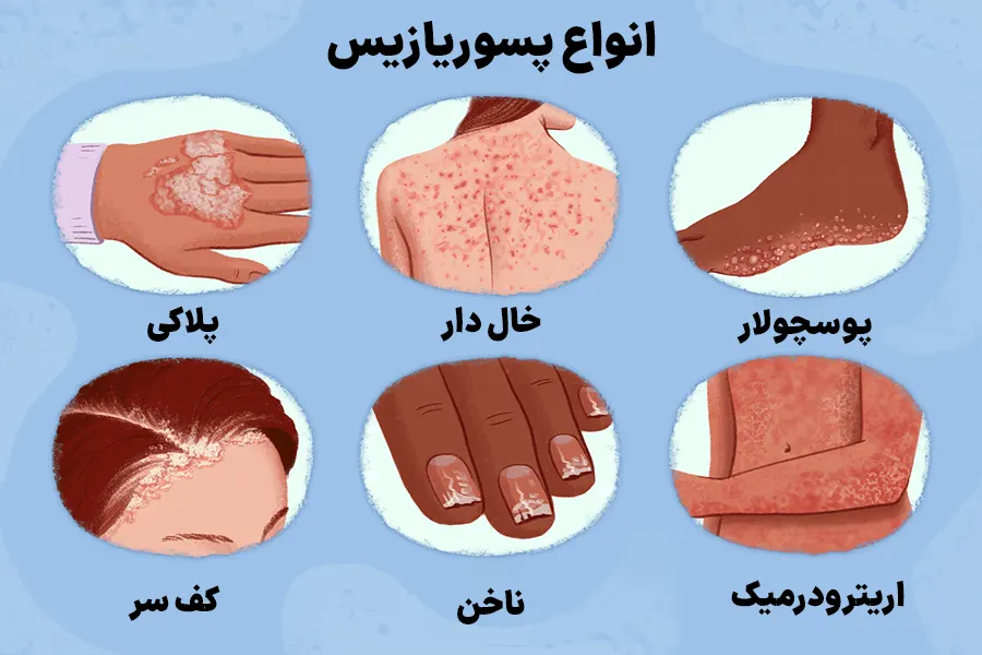 انواع پسوریازیس