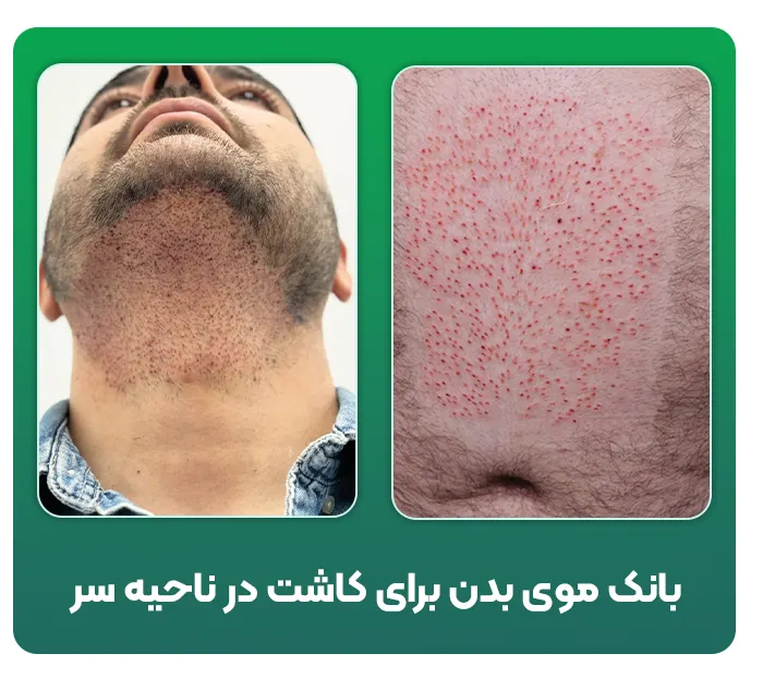 بانک مو بدن
