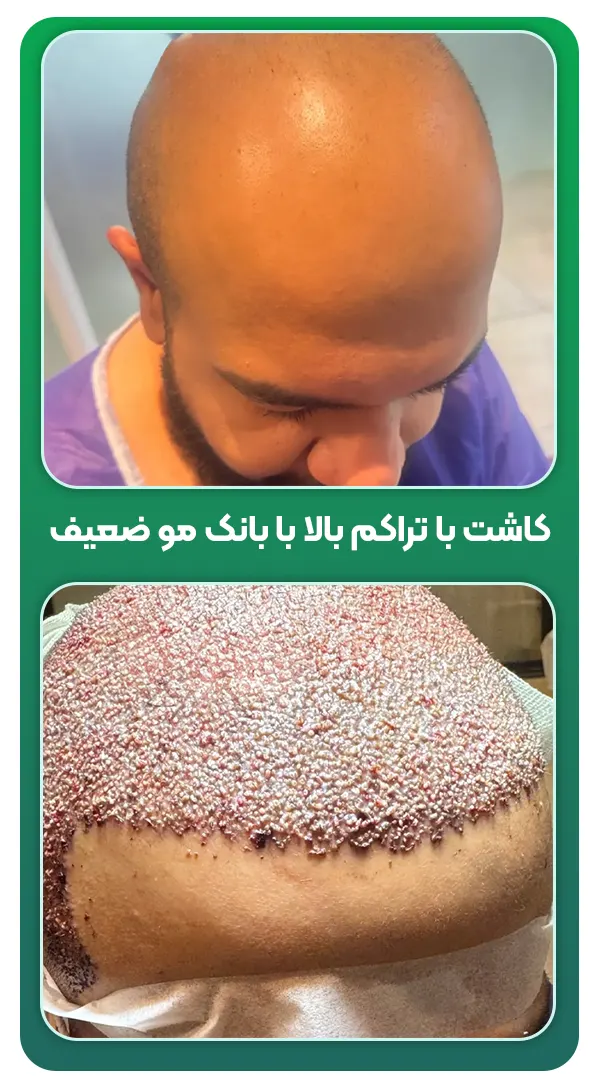 کاشت مو با بانک مو ضعیف