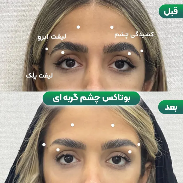 بوتاکس چشم گربه ای