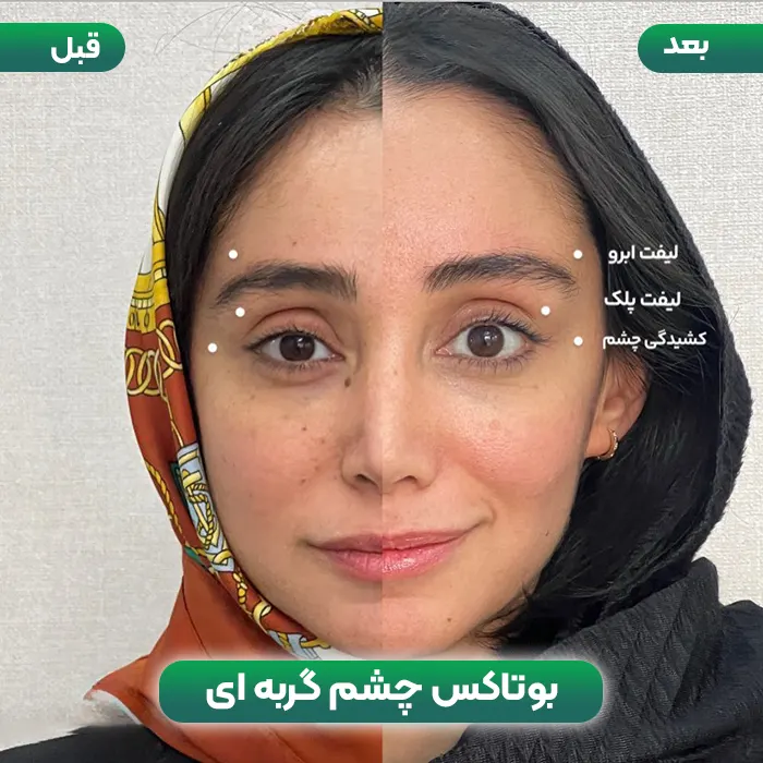 بوتاکس چشم گربه ای