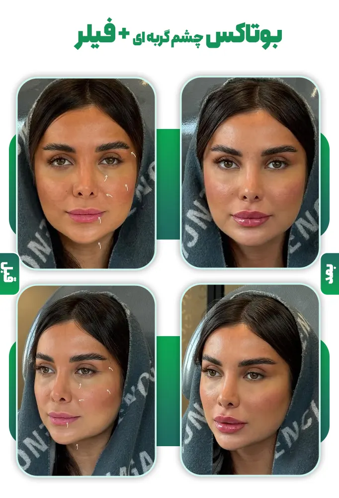 بوتاکس چشم گربه ای قبل و بعد