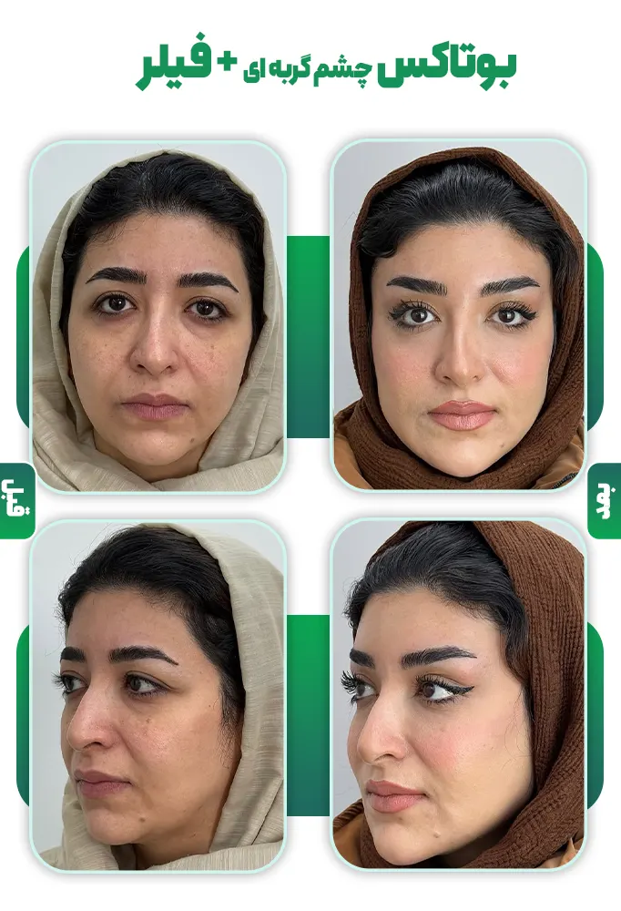 بوتاکس چشم گربه ای