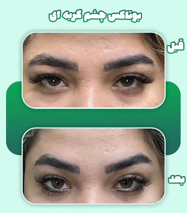 بوتاکس چشم گربه ای