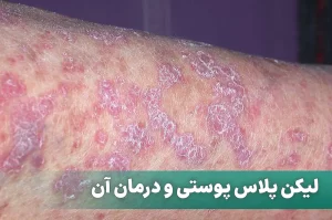 لیکن پلاس پوستی