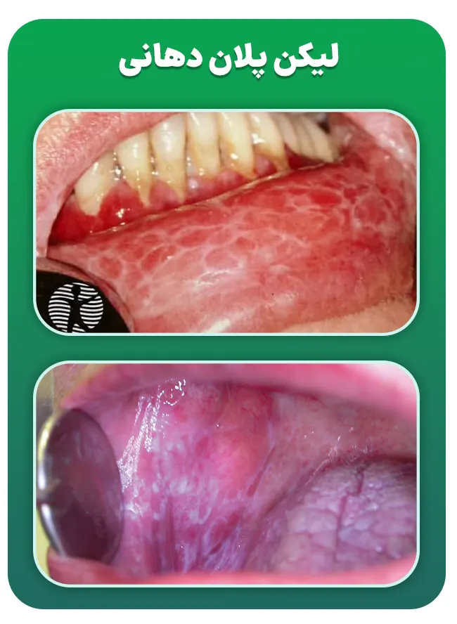 لیکن پلان دهانی