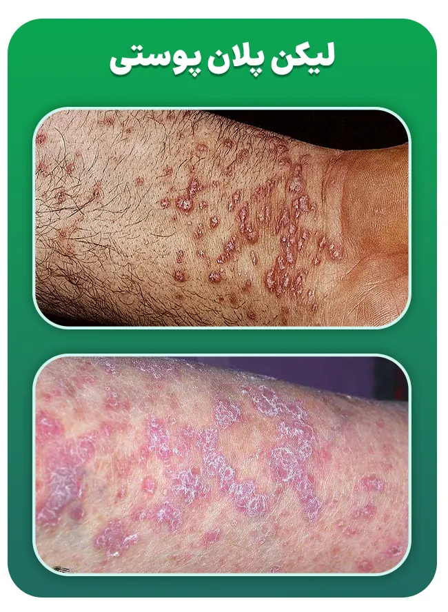 لیکن پلان پوستی