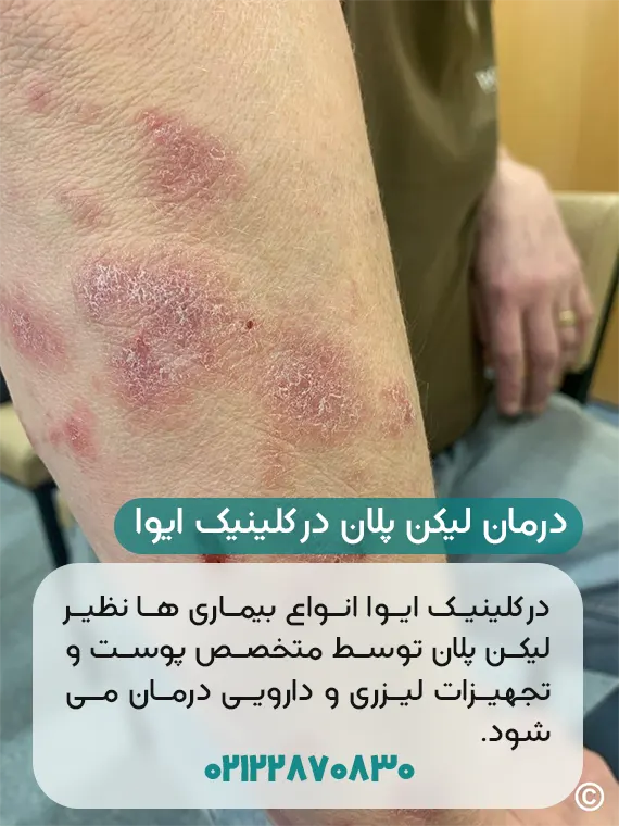 درمان لیکن پلان پوستی