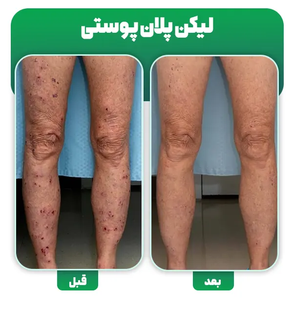 قبل و بعد درمان لیکن پلان پوستی