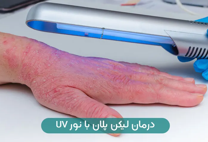 درمان لیکن پلان پوستی با نور UV