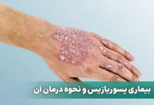 بیماری پسوریازیس